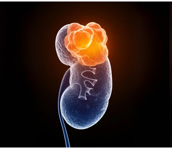 kidneycancer